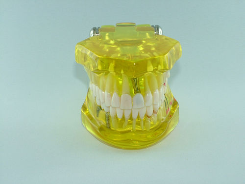 Implantatmodell, artikuliert, mit 8 herausnehmbaren, beweglichen Teile, Klar-Gelb